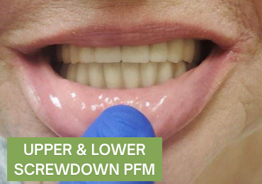 Upper and Lower full arch screw down temporatry